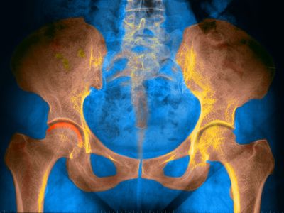 Pelvis, X-ray