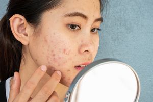 女人在镜子里看脸上的痘痘