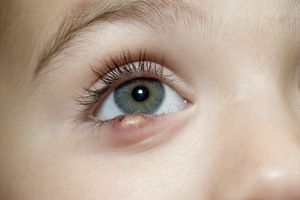 A child with a stye on his lower eyelid.