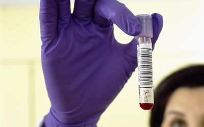 病理学家戴着橡胶手套拿着血液样本的特写