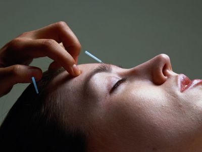 Picture of a woman receiving acupuncture treatment.