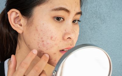 女人在镜子里看脸上的痘痘