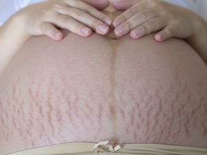 肚子里有妊娠纹